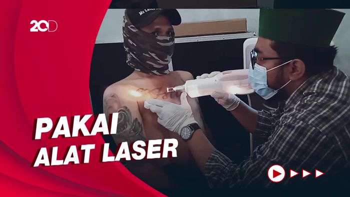Puluhan Orang Ikut Kegiatan Hapus Tato di Klaten, Begini Tekniknya
