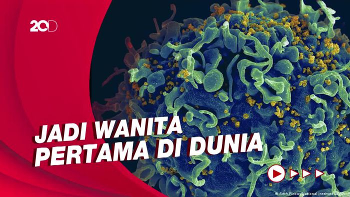 Seorang Wanita Berhasil Sembuh dari HIV Berkat Terapi Sel Punca