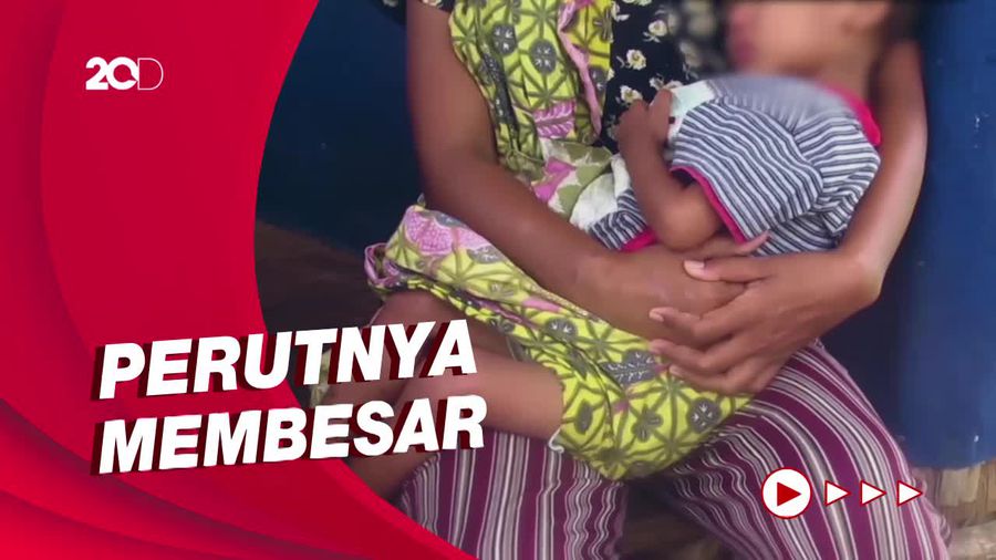 Balita Menderita Tumor Tinggal di Hutan Subang Butuh Bantuan