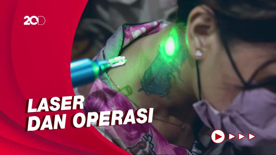 Plus Minus Metode Laser dan Operasi untuk Hapus Tato