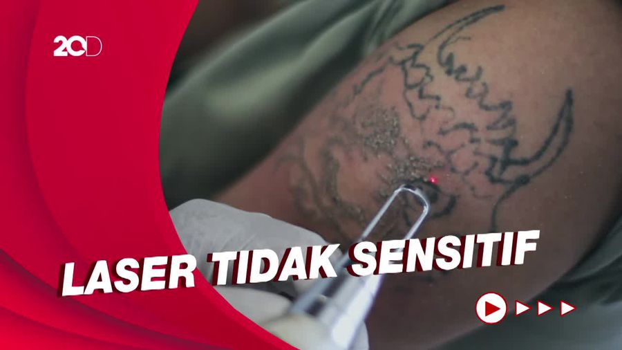 Penyebab Tato Berwarna Sulit Dihilangkan Pakai Laser