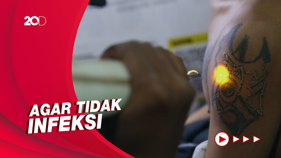 Hal-hal yang Perlu Diperhatikan Jika Hapus Tato Pakai Metode Laser