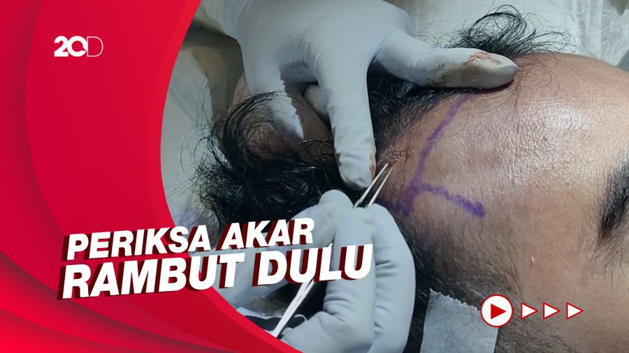 Ingin Implan Rambut? Begini Kata Dokter Kecantikan
