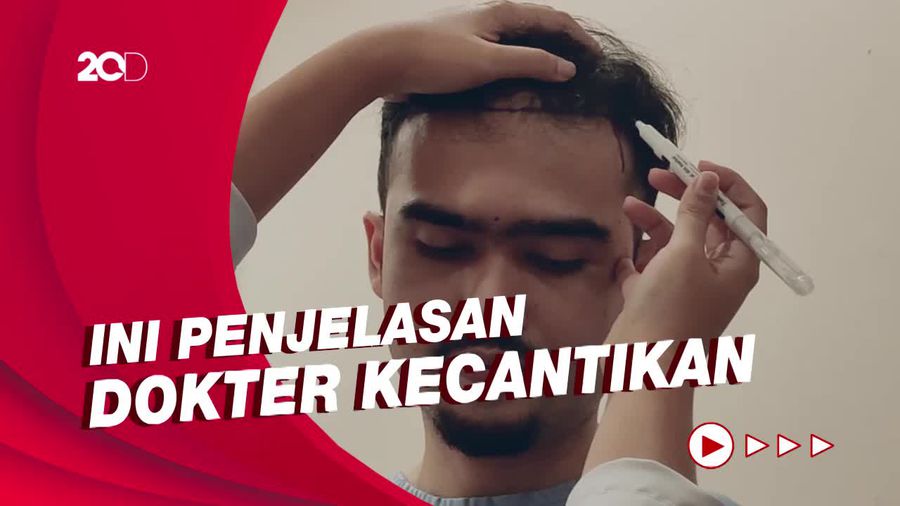Berapa Lama Proses Tumbuhnya Rambut Usai Jalani Implan?
