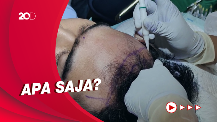 Ini Saran dan Pantangan untuk Pasien Implan Rambut