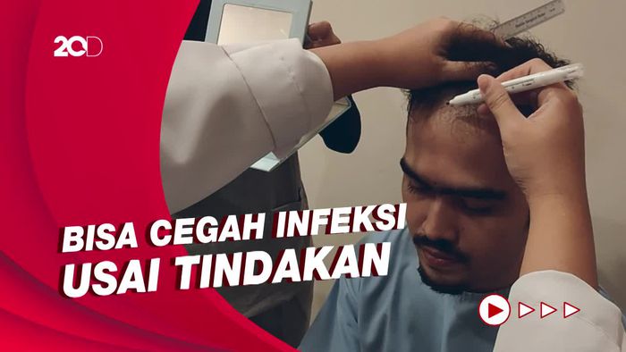 Implan Rambut Tak Timbulkan Efek Samping Kesehatan, Asalkan...