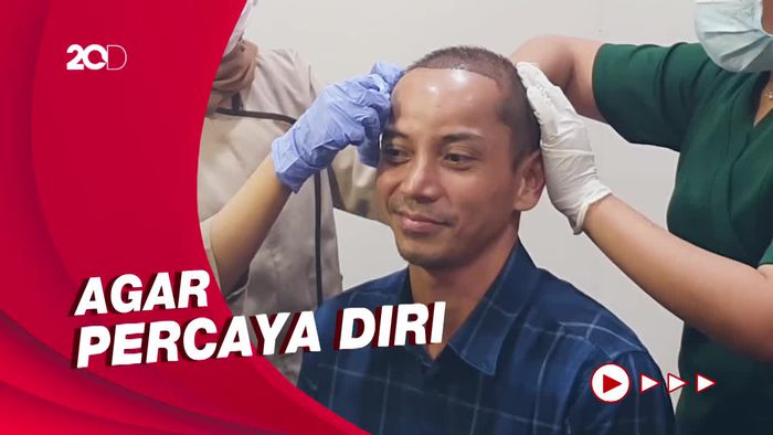 Alasan Fauzi Baadilla Lakukan Transplantasi Rambut