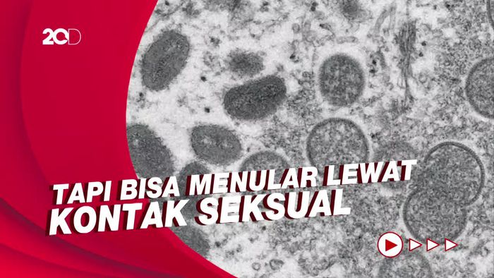 Ahli Sebut Cacar Monyet Bukan Penyakit Menular Seksual