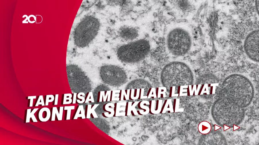 Ahli Sebut Cacar Monyet Bukan Penyakit Menular Seksual