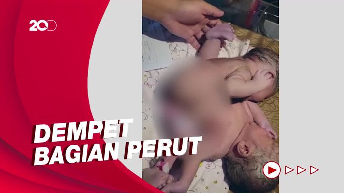 Bayi Kembar Siam Tiga Kaki Lahir dalam Kondisi Sehat di Asahan