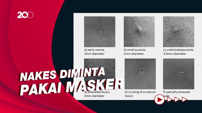 WHO Sebut Ada Kemungkinan Cacar Monyet Menular Lewat Droplet