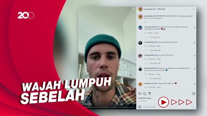 Justin Bieber Perlihatkan Efek Ramsay Hunt Syndrome Pada Wajahnya