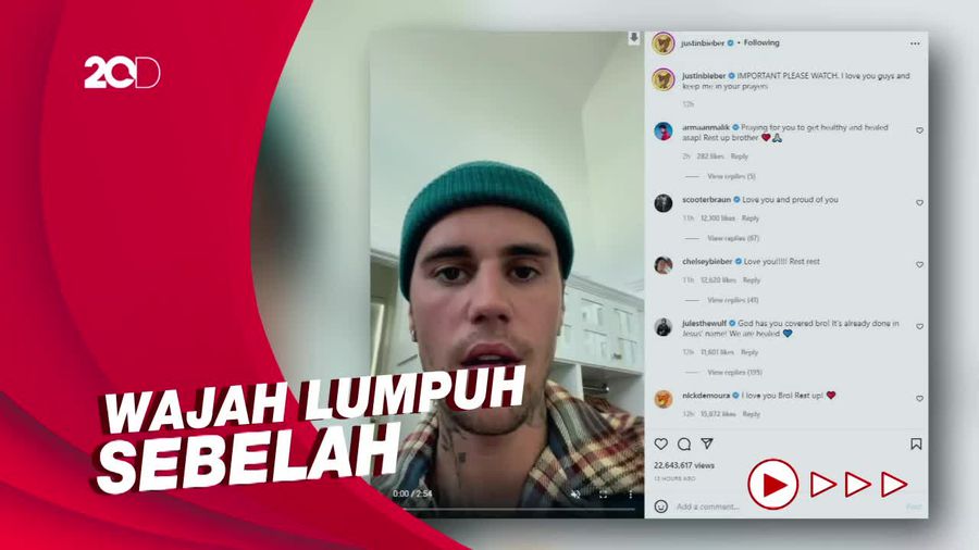 Justin Bieber Perlihatkan Efek Ramsay Hunt Syndrome Pada Wajahnya