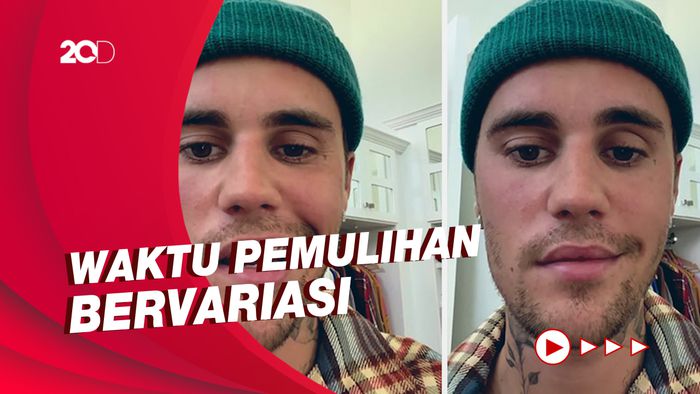 Mengenal Ramsay Hunt Syndrome yang Terjadi pada Justin Bieber