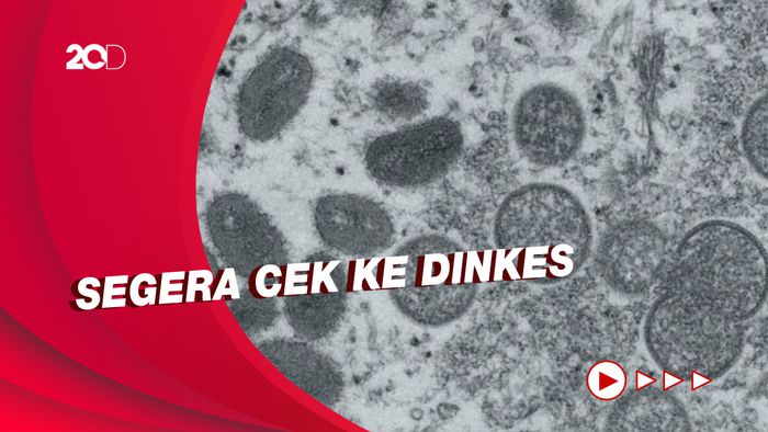 Keterangan Kemenkes soal Kasus Suspek Cacar Monyet di Singkawang