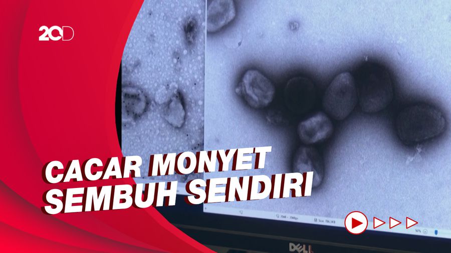Bagaimana Penularan Cacar Monyet?