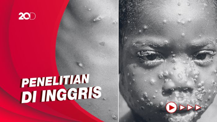 Gejala Cacar Monyet Dilaporkan Mirip Infeksi Menular Seksual