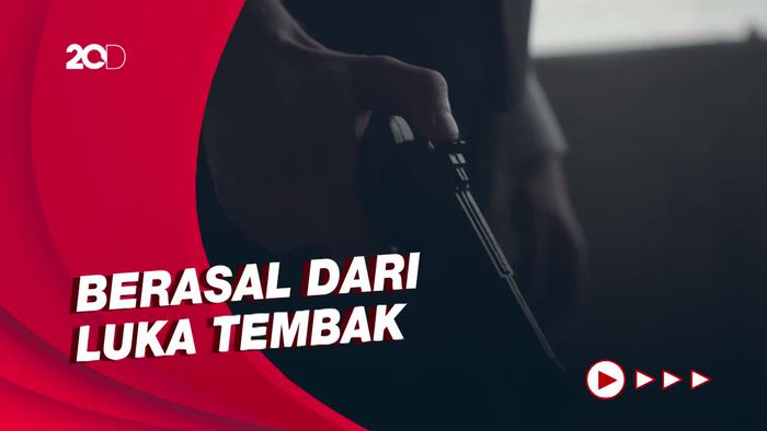 Penjelasan Polisi soal Jari Brigadir J yang Putus
