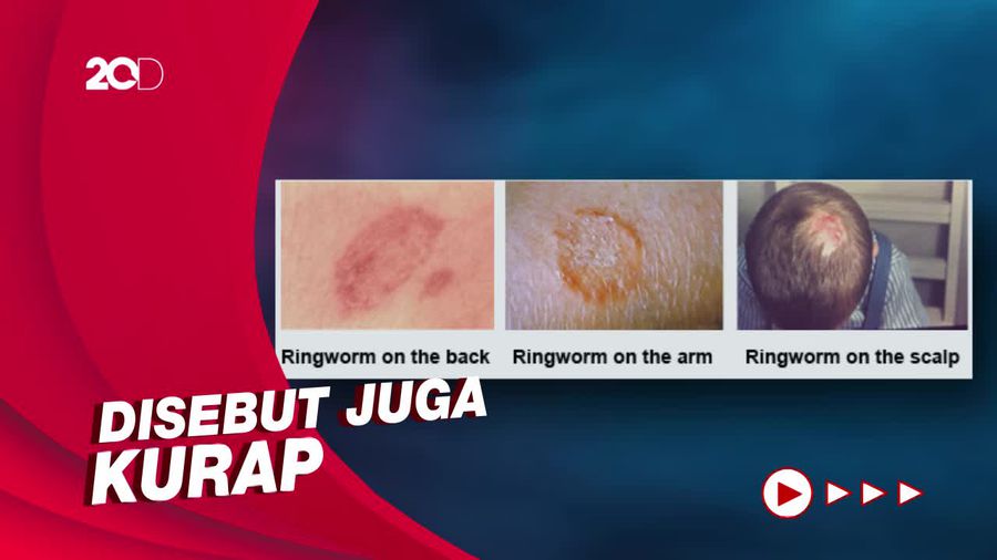 Apa Itu Ringworm? Ini Penyebab dan Cara Penularannya