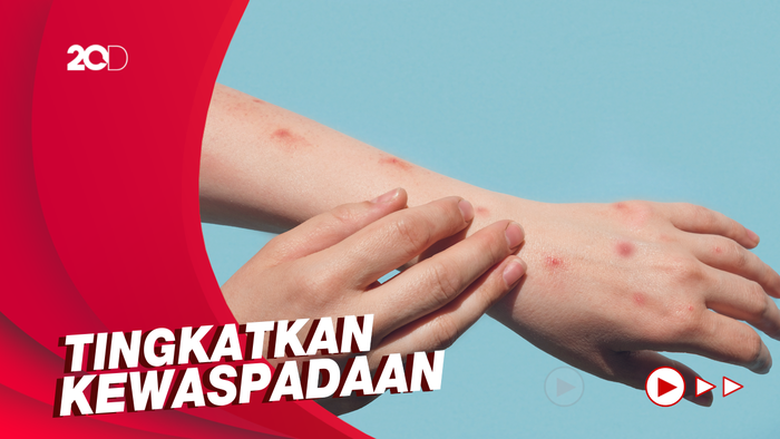 Cacar Monyet Jadi Darurat Kesehatan Global, Indonesia Masih Aman?