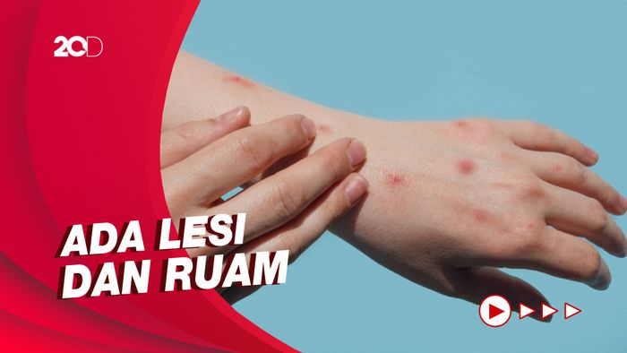 Menkes: Monkeypox Menular Jika Sudah Ada Gejala