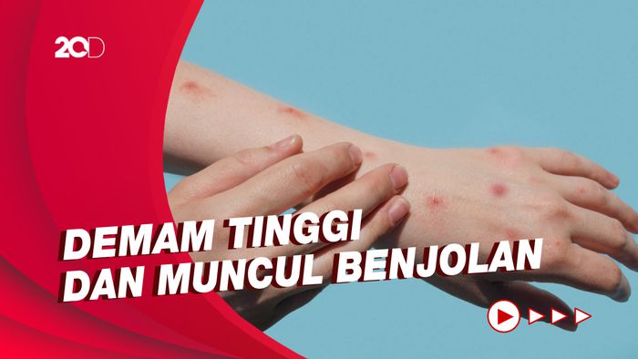 Kemenkes Beberkan Gejala Khusus dari Cacar Monyet