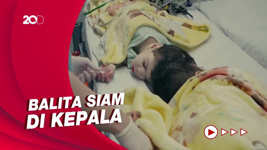 Melihat Operasi Balita Kembar Siam di Brazil yang Berlangsung 27 Jam