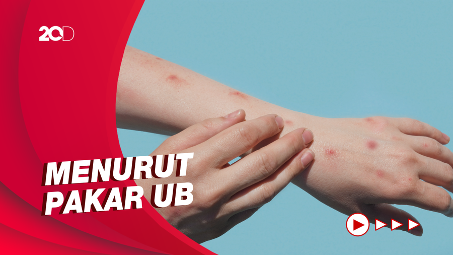 3 Fase yang Dialami Pasien Terinfeksi Cacar Monyet