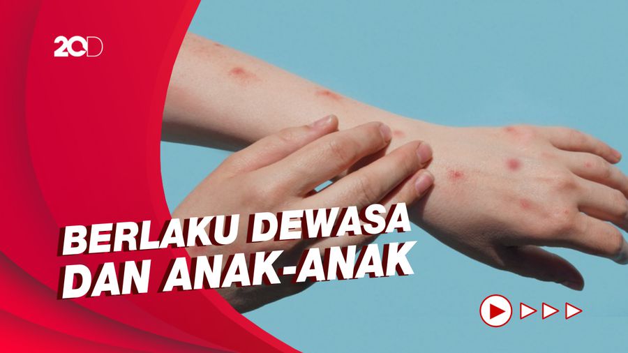 Sudah Terlanjur Kena Cacar Monyet, Bagaimana Penanganannya?