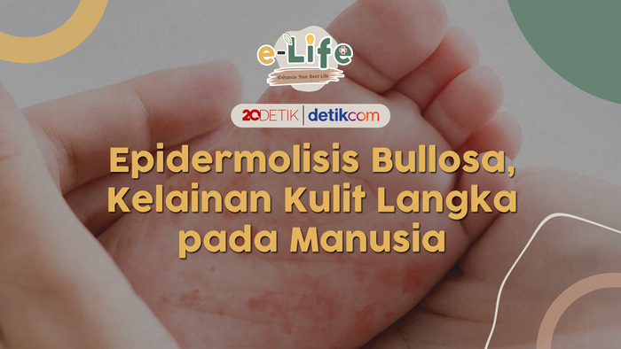 Epidermolisis Bullosa, Kelainan Kulit Langka Pada Manusia