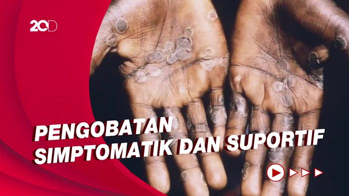 Kata Perhimpunan Dokter Kulit Indonesia soal Pengobatan Cacar Monyet