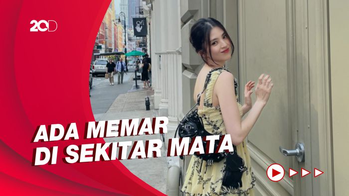 Kondisi Terbaru Han So Hee Usai Cedera di Lokasi Syuting