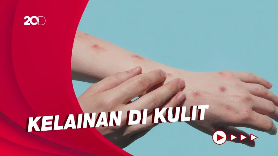 Kenali Gejala Awal Cacar Monyet