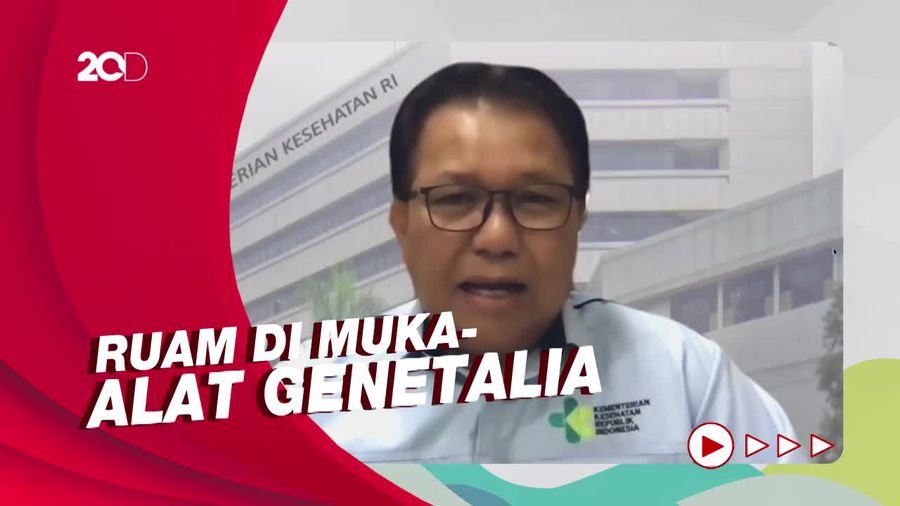 Kondisi Pasien Cacar Monyet Pertama di RI: Baik, Tidak Sakit Berat