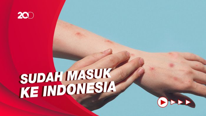 Pakar IDI Ingatkan Masyarakat Waspada Cacar Monyet