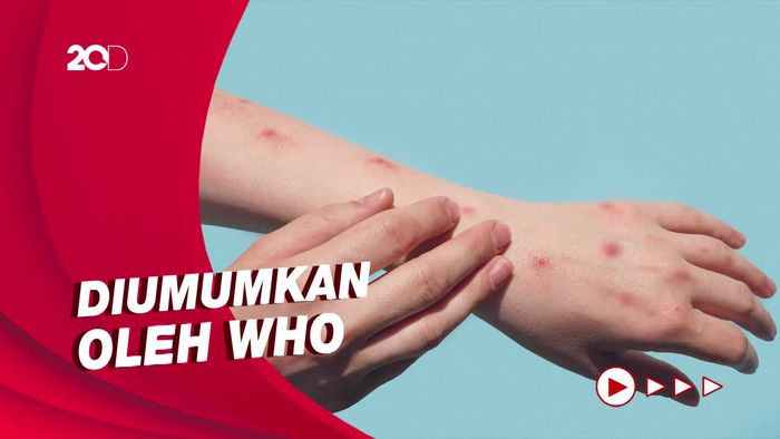 Jumlah Kasus Cacar Monyet Global Menurun