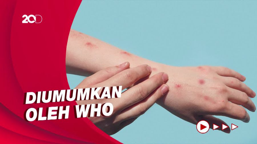 Jumlah Kasus Cacar Monyet Global Menurun