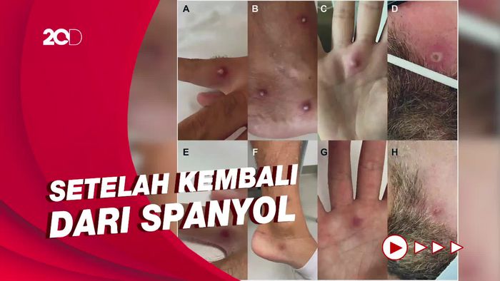 Pria Italia Menderita Covid-19, Cacar Monyet dan HIV di Hari yang Sama