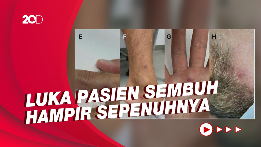 Kondisi Terkini Pasien Italia yang Positif Covid-19, Cacar Monyet dan HIV