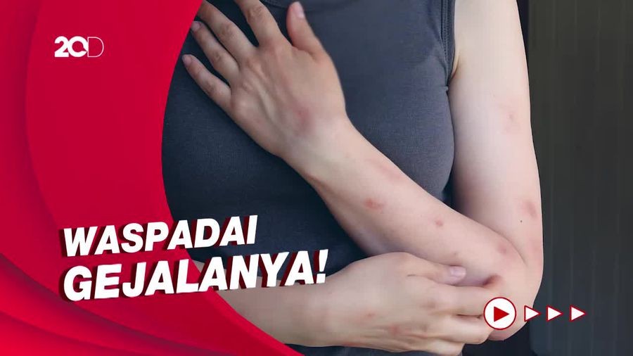 Perbedaan Mencolok Gejala Awal Covid-19 dan Cacar Monyet