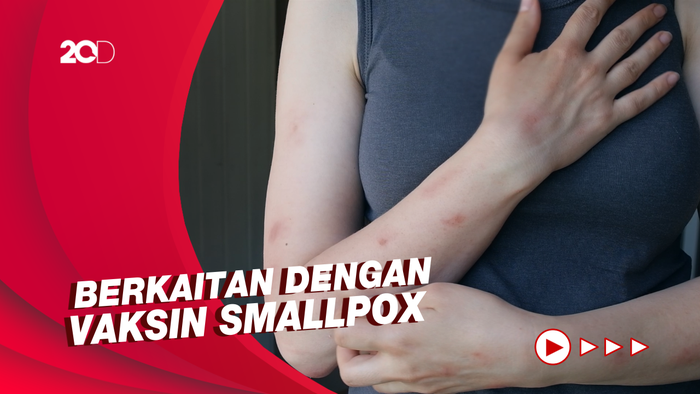 Menkes Budi Ungkap Alasan Kasus Cacar Monyet di Asia Tak Setinggi Eropa