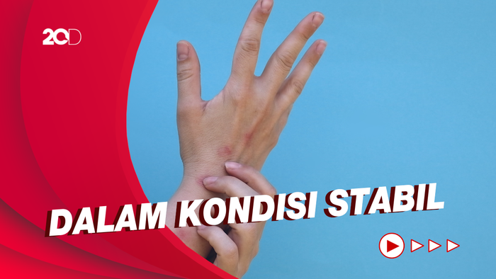 Spanyol Laporkan Penurunan Kasus Cacar Monyet