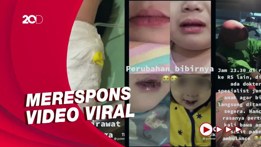 Dirut BPJS Pastikan Pengobatan Penyakit Kawasaki Ditanggung BPJS