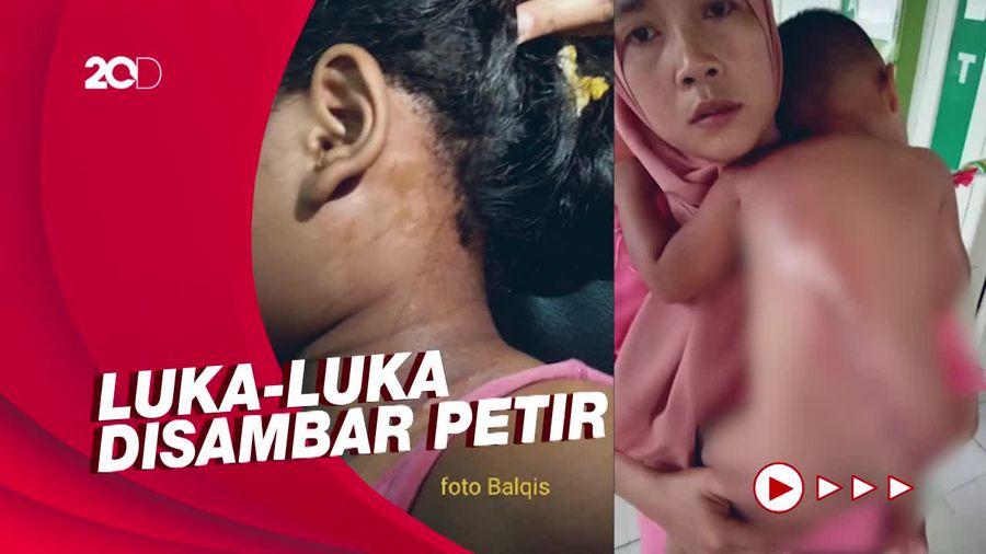 Dua Bocah di Lampung Tersambar Petir, Kondisinya Selamat
