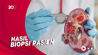 Hasil Biopsi Tunjukkan Ginjal Pasien Anak Rusak Karena Etilen Glikol