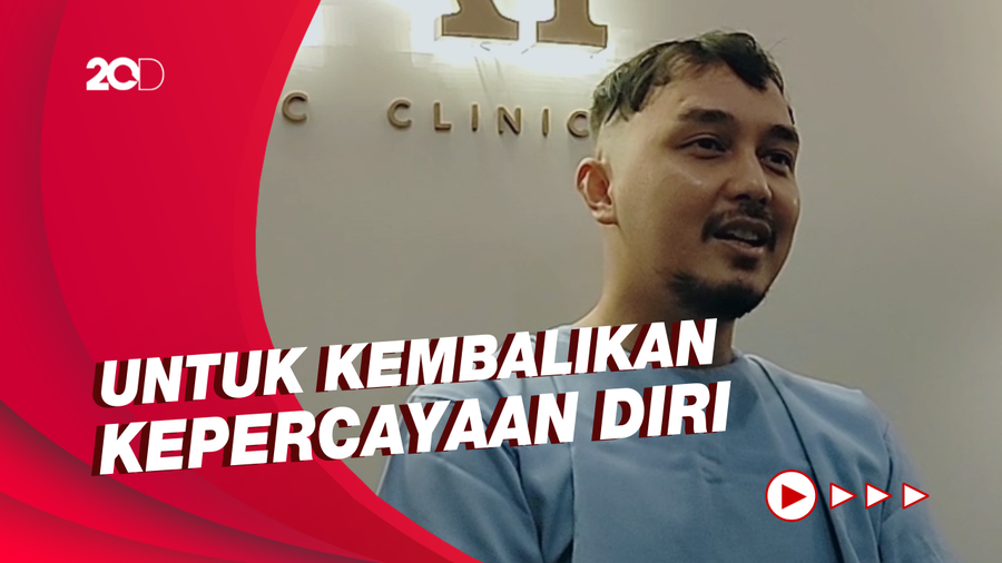 Alami Kebotakan Dini, Aktor Dimas Aditya Jalani Tranplantasi Rambut 