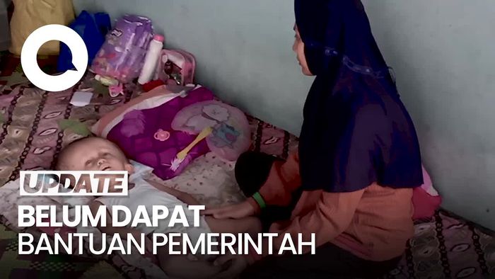 Pilu Orang Tua di Jambi Rawat Anak Hidrosefalus, Terkendala Biaya ke RS