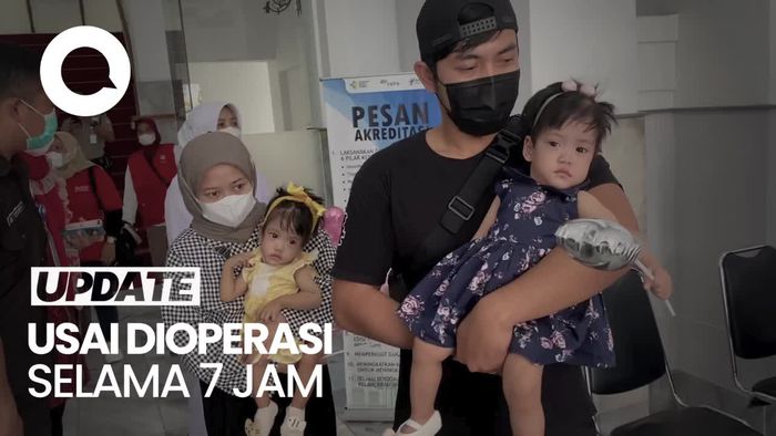  Senangnya Ortu Melihat Anaknya yang Kembar Siam Kembali Normal