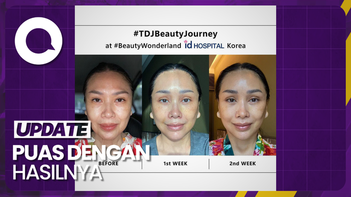 Titi DJ Beberkan Alasan Lakukan Oplas Anti Aging di Korea Selatan