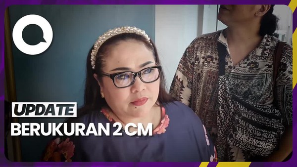 Hasil Biopsi Nunung: Kanker Payudara Stadium 2